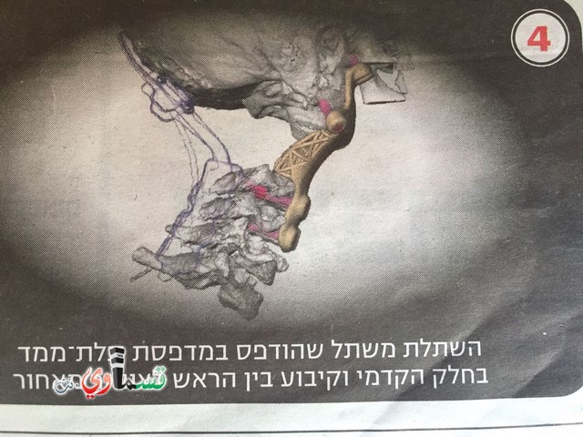  كفرقاسم : الطفلة ثراء عارف عامر تجتاز بنجاح احدى العمليات الجراحية الأكثر ندرة وتعقيدا في إسرائيل